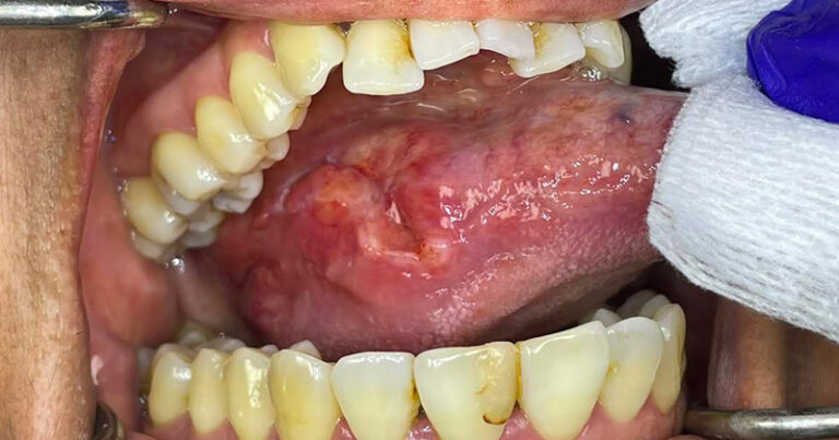 CANCERBUCAL